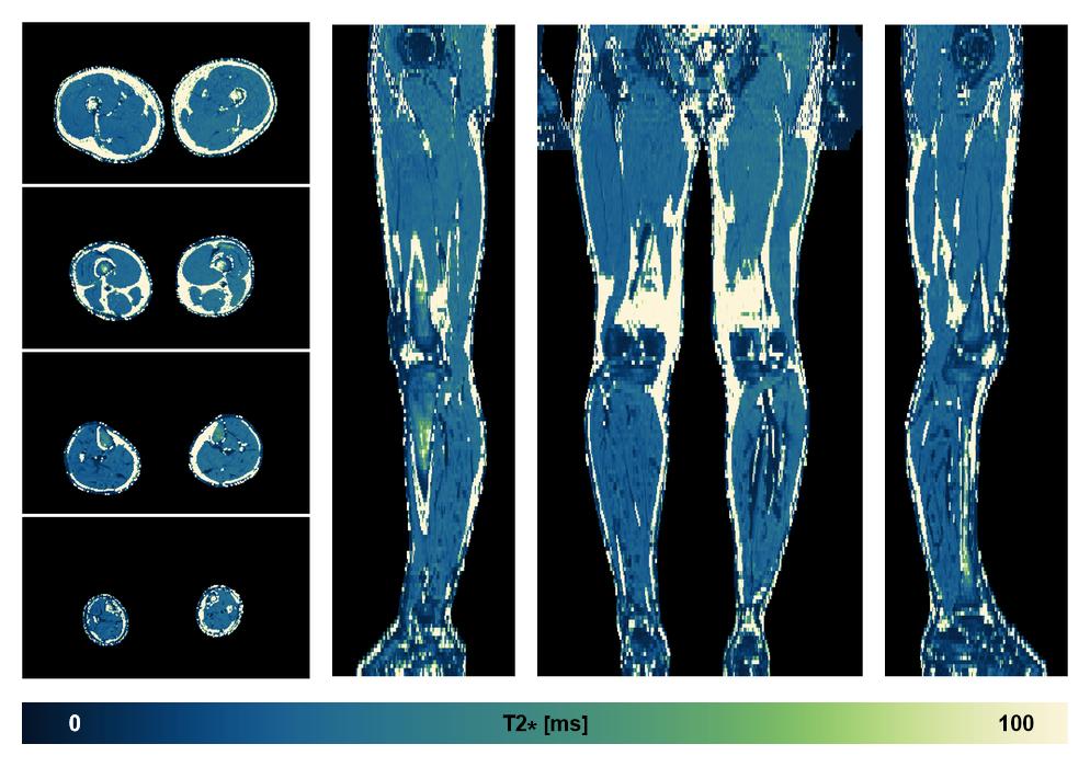 The T2 star relaxation time of the lower extremity obtained from the dixon reconstruction for muscle water fat quantification.